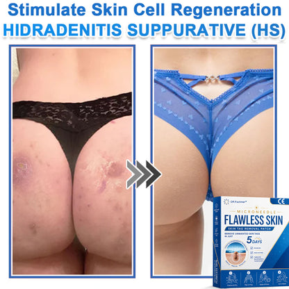 🩹 𝑫𝑹.𝑭𝒂𝒄𝒉𝒎𝒆𝒓® 2-𝒊𝒏-1 𝑴𝒊𝒄𝒓𝒐𝒏𝒆𝒆𝒅𝒍𝒆 & 𝑯𝒚𝒅𝒓𝒐𝒄𝒐𝒍𝒍𝒐𝒊𝒅 𝑷𝒂𝒕𝒄𝒉 | 𝑹𝒂𝒊𝒔𝒆𝒅 𝑴𝒐𝒍𝒆𝒔,𝑨𝒄𝒏𝒆,  𝑭𝒍𝒂𝒕 𝑾𝒂𝒓𝒕𝒔 & 𝑺𝒌𝒊𝒏 𝑻𝒂𝒈𝒔 𝑹𝒆𝒎𝒐𝒗𝒆𝒓 | 𝑰𝒎𝒑𝒓𝒐𝒗𝒆𝒔 𝑾𝒓𝒊𝒏𝒌𝒍𝒆𝒔, 𝑺𝒄𝒂𝒓𝒔 & 𝑩𝒍𝒆𝒎𝒊𝒔𝒉𝒆𝒔 | 𝑰𝒏𝒗𝒊𝒔𝒊𝒃𝒍𝒆 𝑷𝒊𝒎𝒑𝒍𝒆 𝑷𝒂𝒕𝒄𝒉𝒆𝒔 𝒇𝒐𝒓 𝑭𝒂𝒄𝒆 & 𝑩𝒐𝒅𝒚
