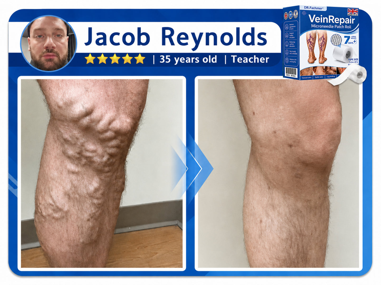🌿DR.Fachmer® Vein Ease Microneedle Care Patch(For Spider Veins, Varicose Veins, Swelling & Leg Fatigue) - Last Day Promotion 50% OFF
