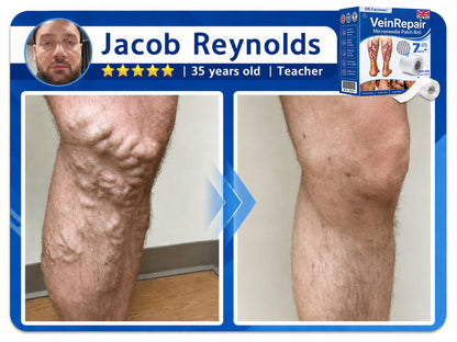 🌿DR.Fachmer® Vein Ease Microneedle Care Patch(For Spider Veins, Varicose Veins, Swelling & Leg Fatigue) - Last Day Promotion 50% OFF