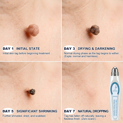 ✍️Official Brand Store | Rolimey® 🖊️ 7-Day Tag & Spot Eraser (Zero Pain, Zero Scars Rollerball) 🌱
