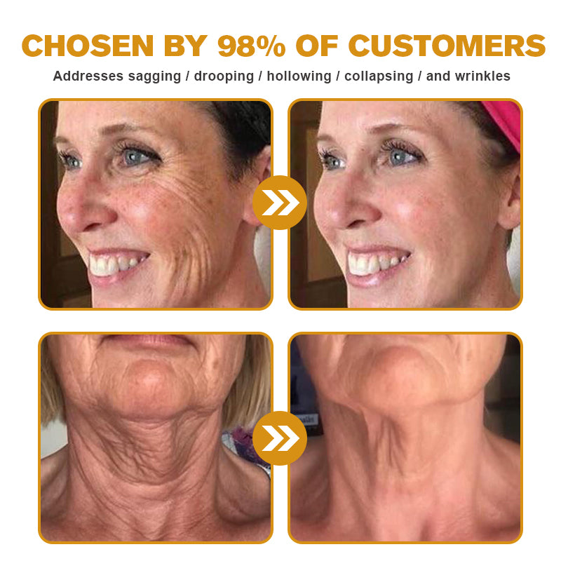 🌲👩‍⚕️(🐝Made and Shipped from UK✅) Furzero™ Botox Bee Venom Wrinkle Removal Cream- LAST DAY 70% OFF